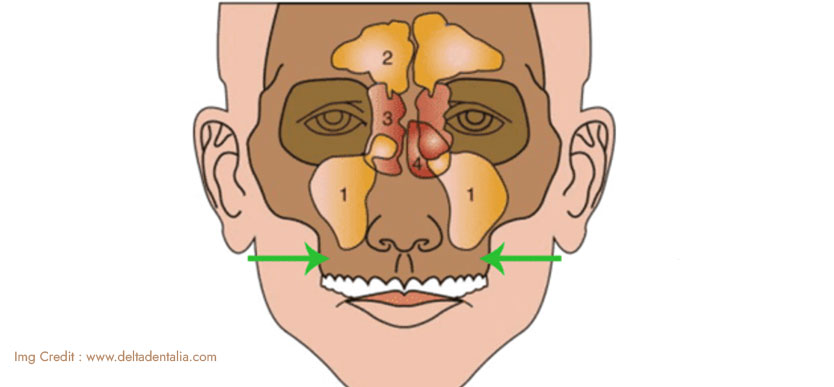 Paranasal Sinus (PNS) Cancer